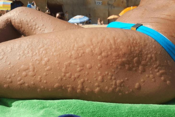 Dia Mundial da Alergia – 8 de julho